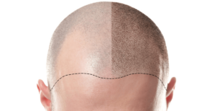 Follicular Unit Transplantation - Before and After