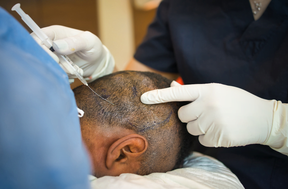 hair transplant scar maxim hair restoration