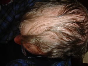 hair transplant failure