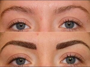 hair transplant to eyebrows