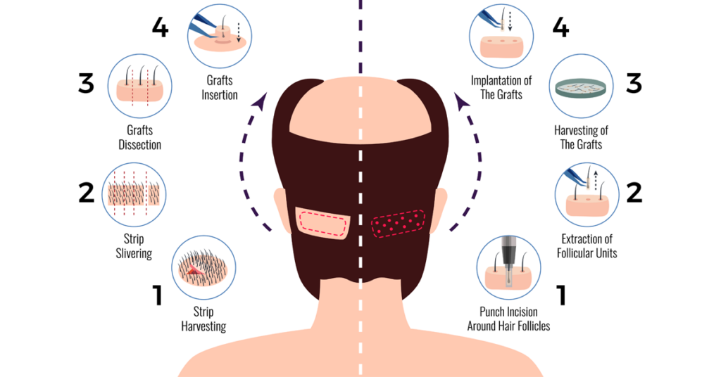 FUE & FUT Hair Transplant Comparison