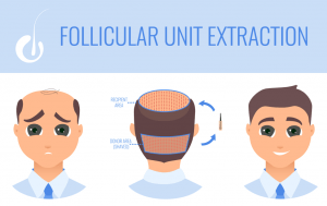 fue hair transplant