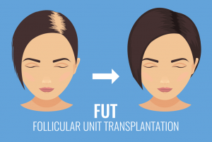 Follicular Unit Transplant (FUT)