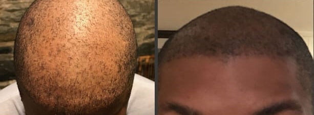 scalp micropigmentation