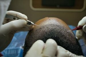 hair transplant surgery