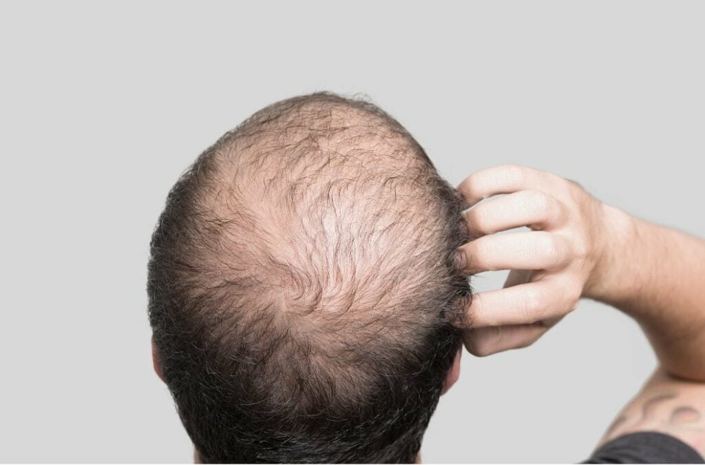 male pattern baldness