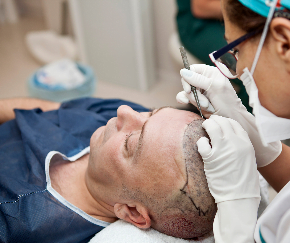 What Is Scalp Micropigmentation?