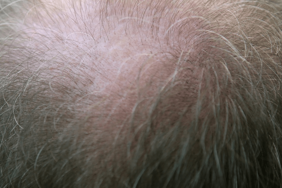 Bald Spot