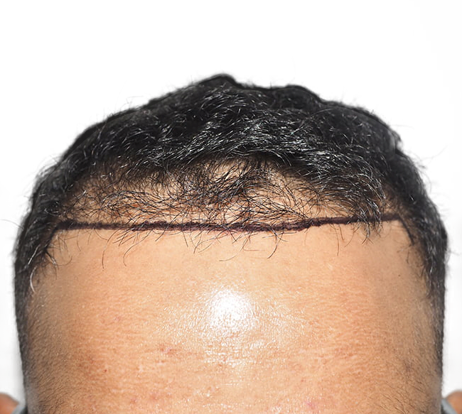 Hair Transplants for Curly Hair