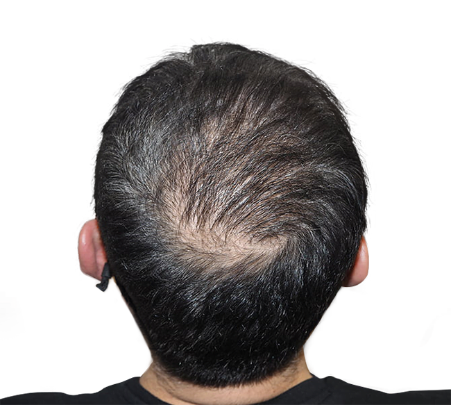 After Crown Hair Transplant 2