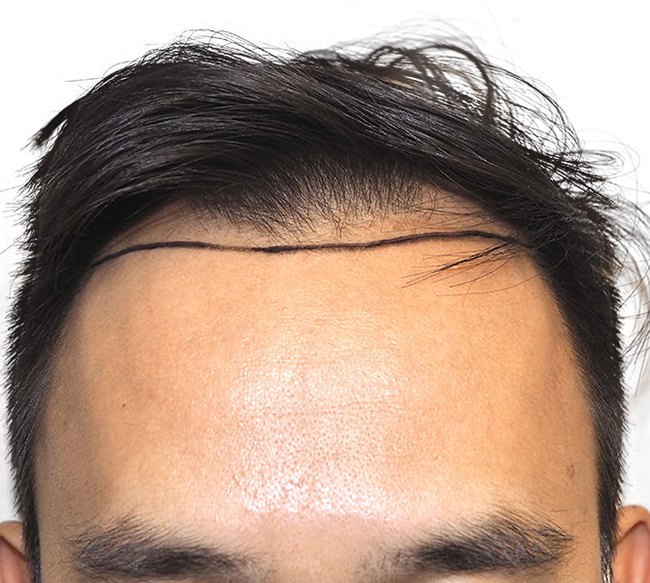 FUE Hair Transplants in Tampa, FL