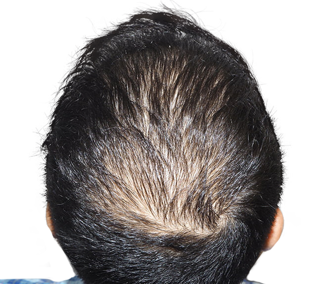 Before Crown Hair Transplant