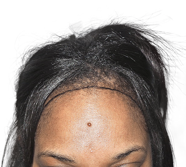 African American Hair Transplant