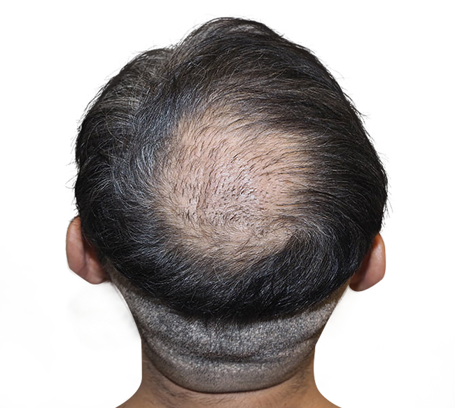 Before Crown Hair Transplant 2