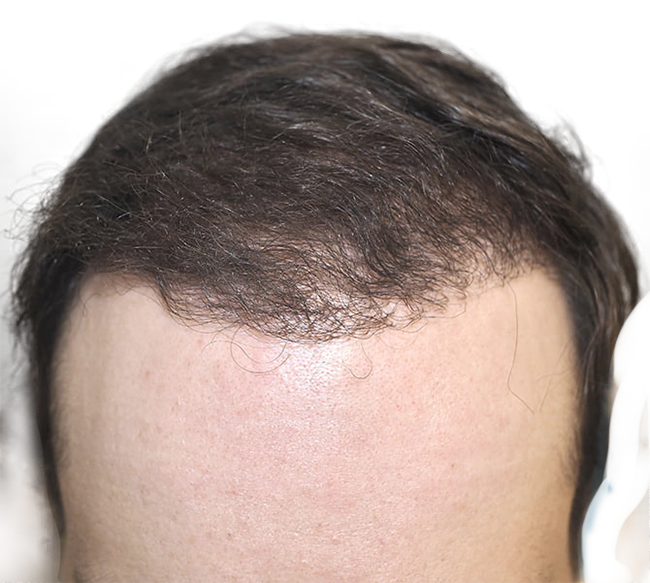 FUE Hair Transplants in Fort Worth, TX