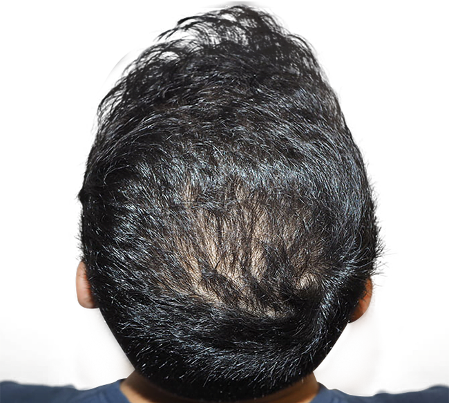 After Crown Hair Transplant