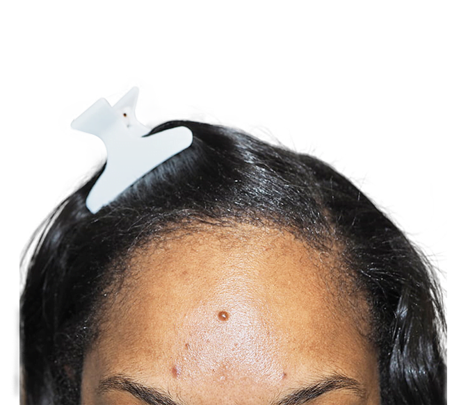 African American Hair Transplant