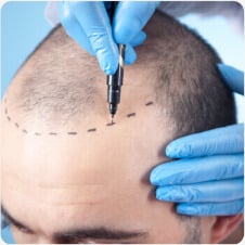 Hair transplant prep: Man with receding hairline marked for procedure. Before hair restoration. Surgical planning.