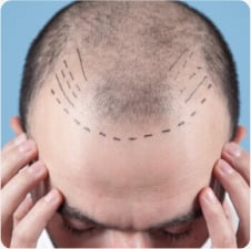 Hair transplant planning: Man with receding hairline marked for hair restoration procedure. Before/after results not shown.