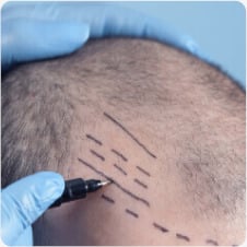 Hair transplant planning: Scalp marked for follicle placement. Surgical glove & marker visible. Hair restoration procedure prep.