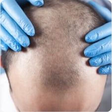 Hair thinning assessment. Scalp exam for hair transplant. Dark hair, light skin. Hair restoration consultation.