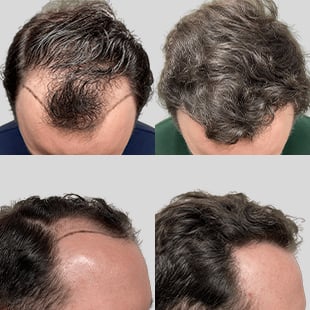 Hair transplant before & after: See restored hairline and fuller hair density. Caucasian man. Hair restoration results.