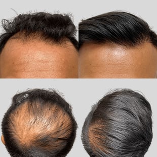 Hair transplant before & after: Restored hairline & crown. Improved hair density. Hair restoration results.