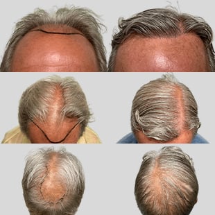 Hair transplant before & after: Caucasian male. Receding hairline & thinning crown restored with hair restoration surgery.