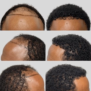 Hair transplant before & after: African American man. Restored hairline, fuller, textured hair. Hair restoration results.