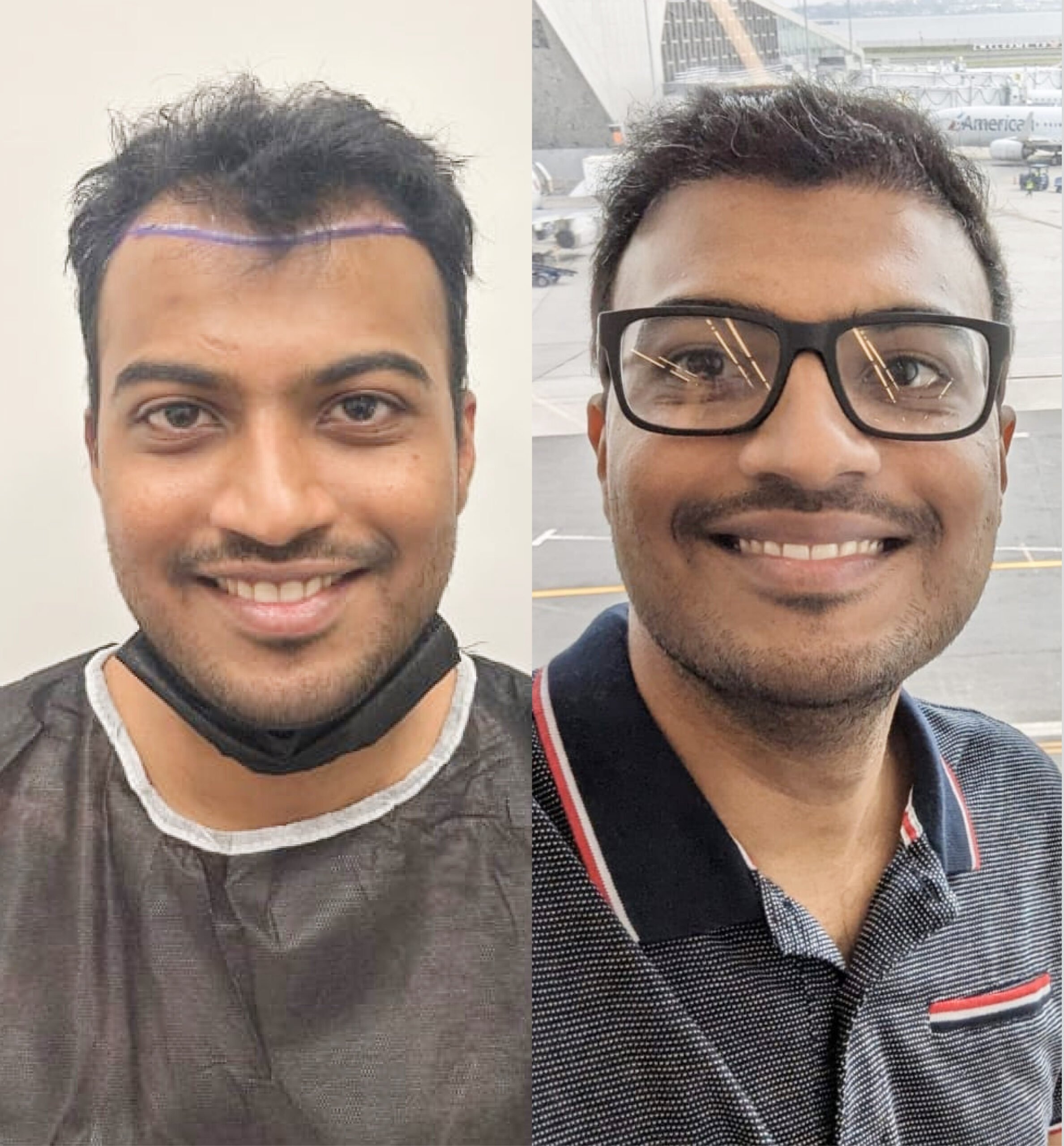 Hair transplant before & after: Indian man's receding hairline restored. Fuller, thicker hair achieved. See the results!