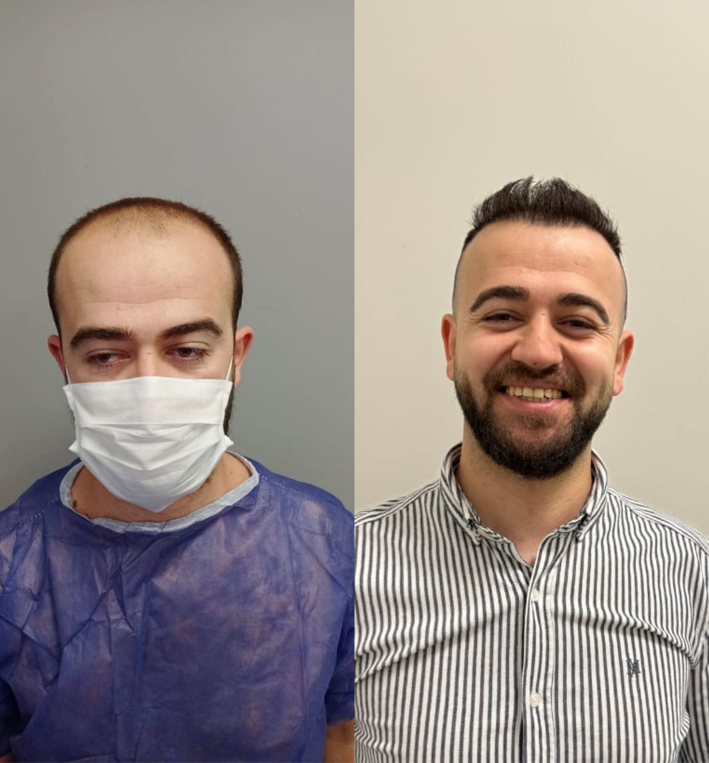 Hair transplant before & after. Man's hair restoration results. See the difference!