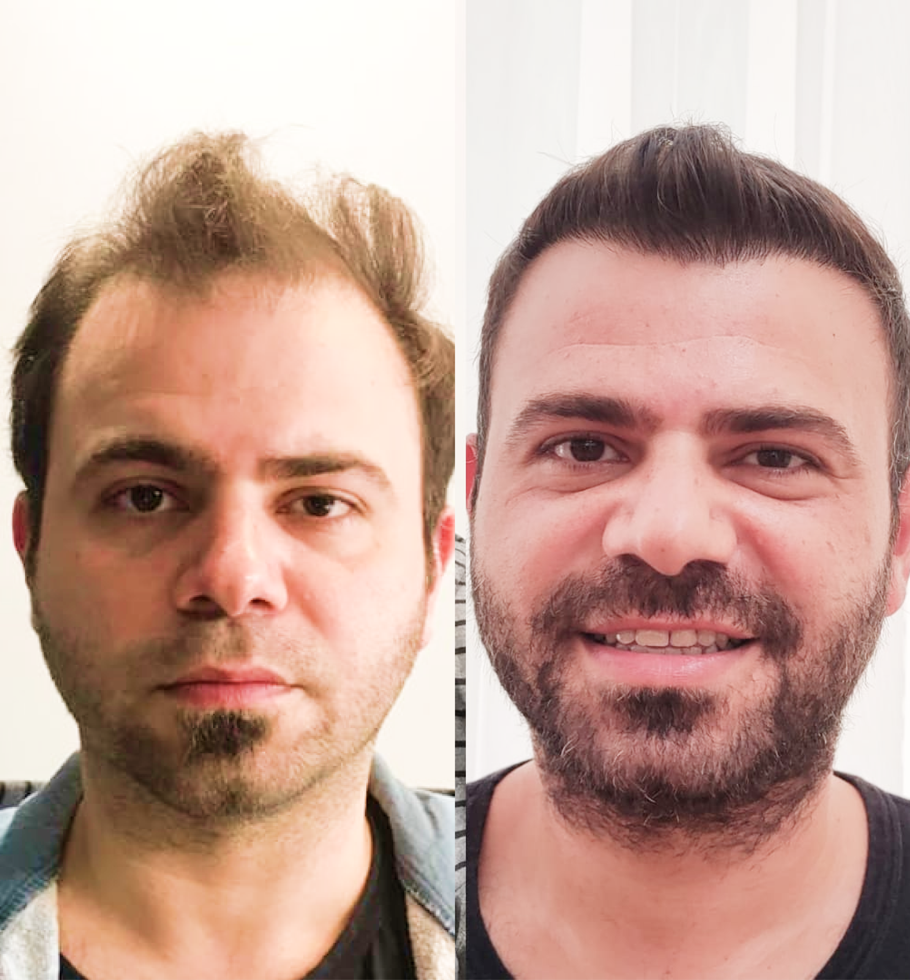 Hair transplant before & after: Man with restored hairline. Natural-looking hair restoration results.