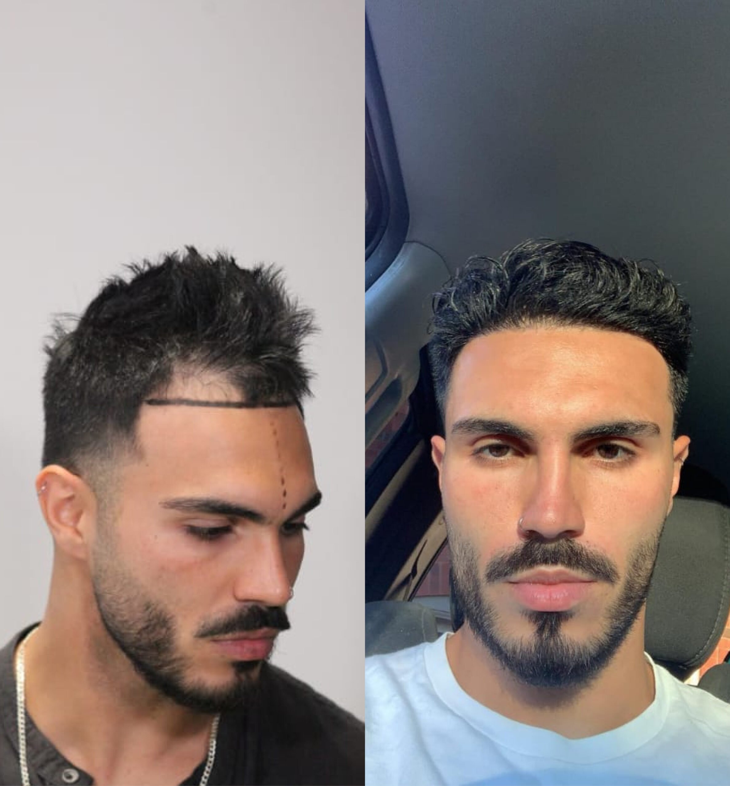 Hair transplant before & after: Hispanic man with restored hairline. Noticeable hair restoration results.