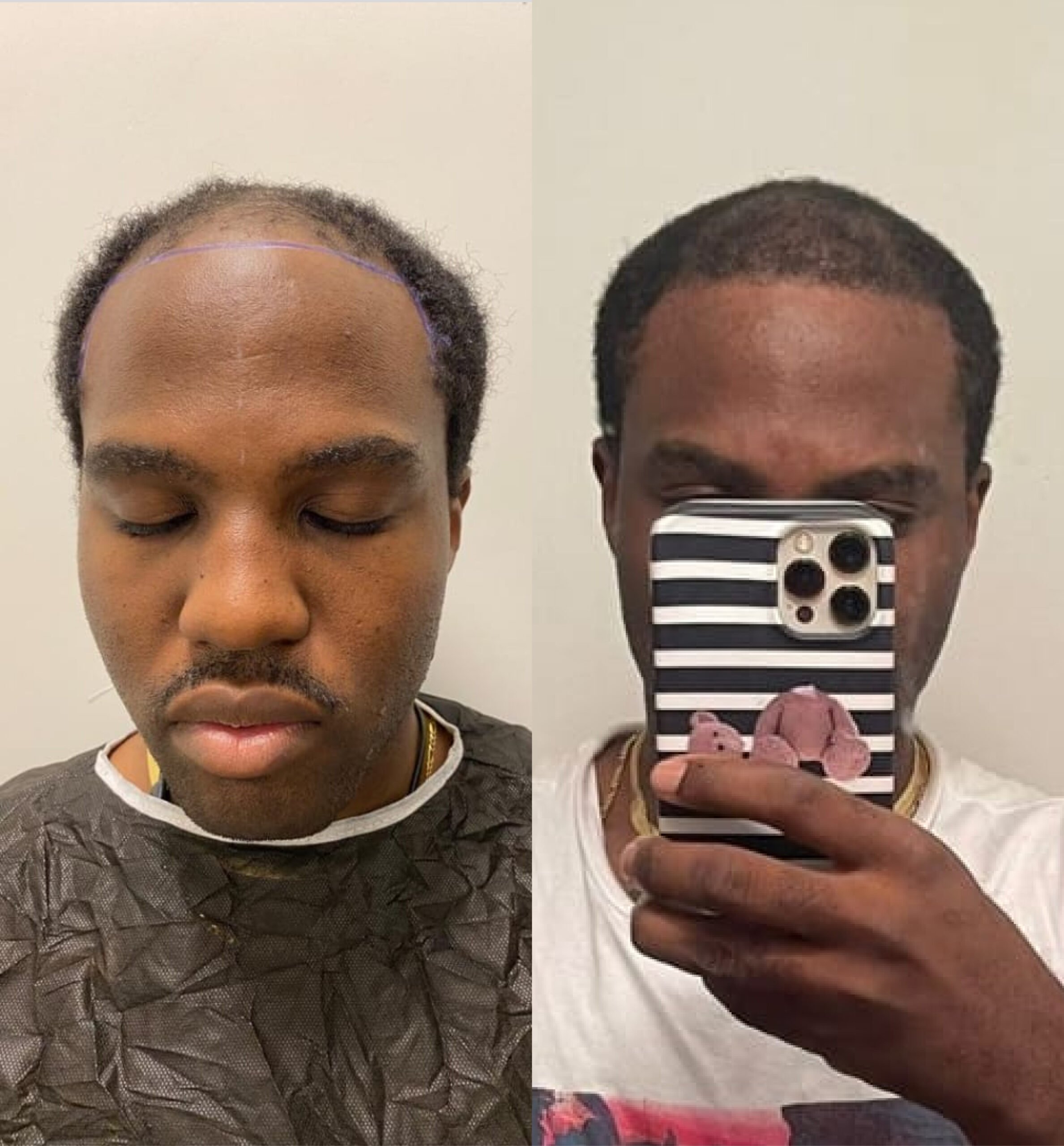 Hair transplant before & after: African American man. Receding hairline restored. Improved hair density. Hair restoration results.