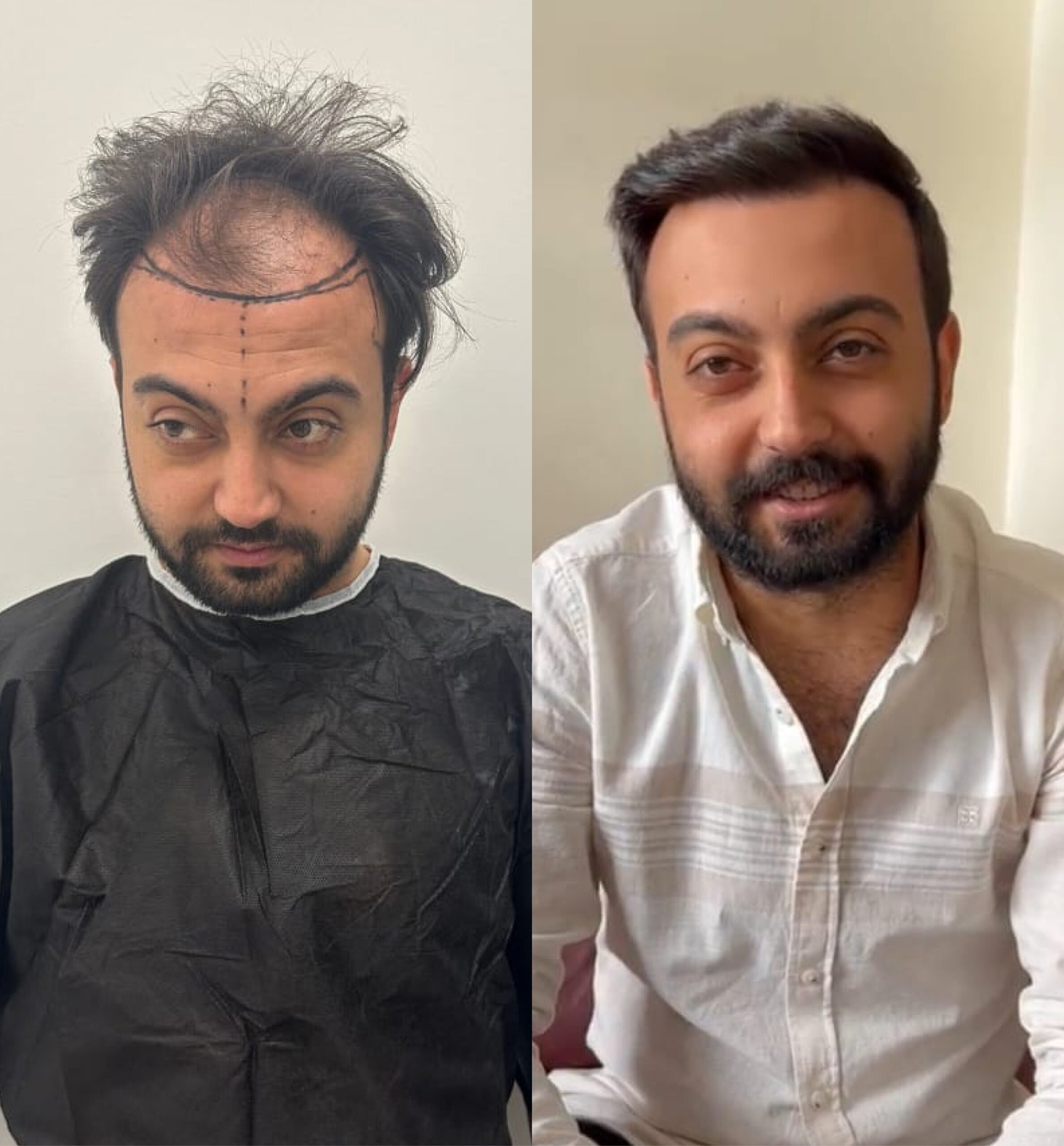 Hair transplant before & after: See the dramatic hair restoration results. Man with fuller hair after procedure.