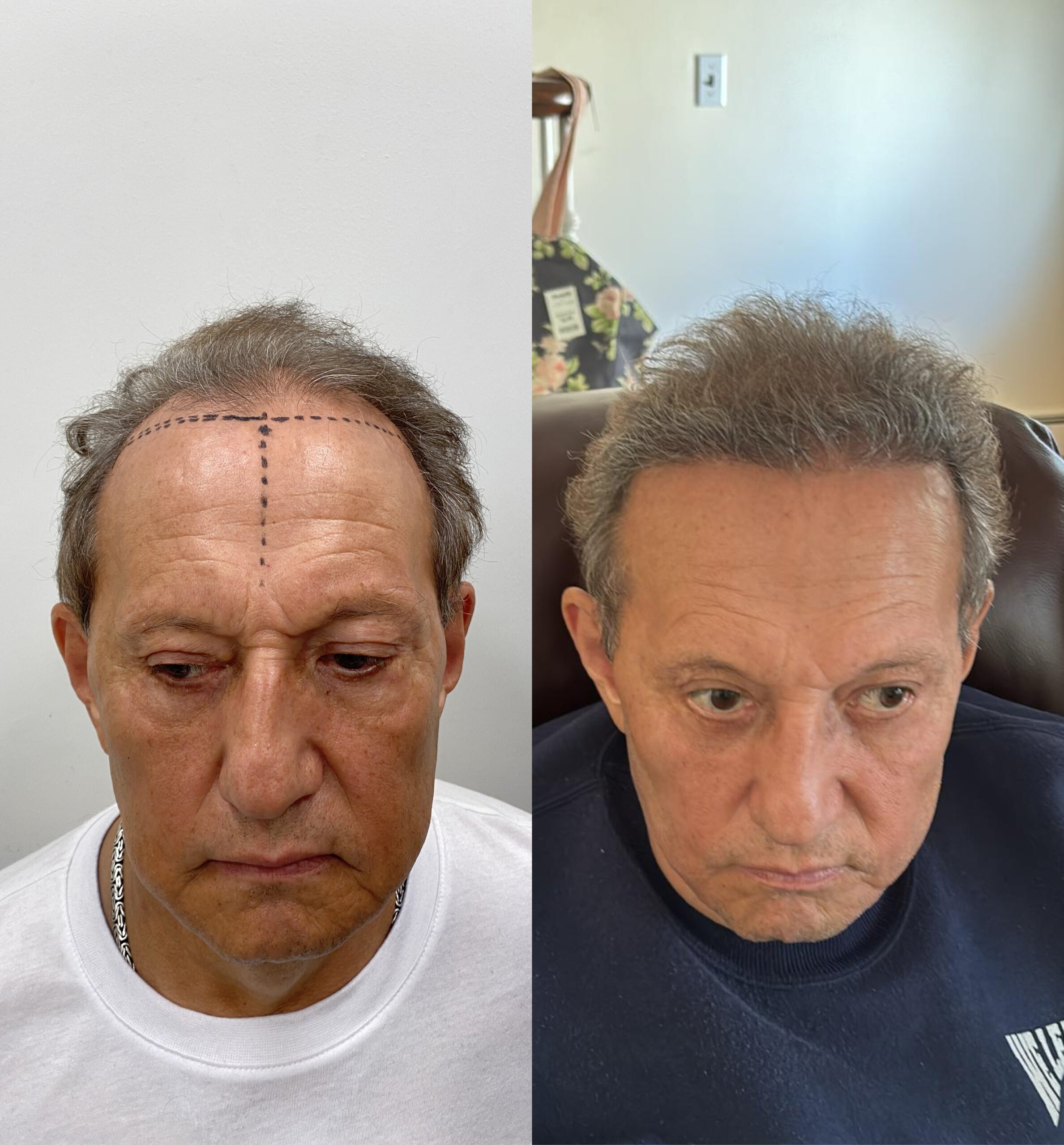 Hair transplant before & after. Man's hair restoration results shown. See the difference!