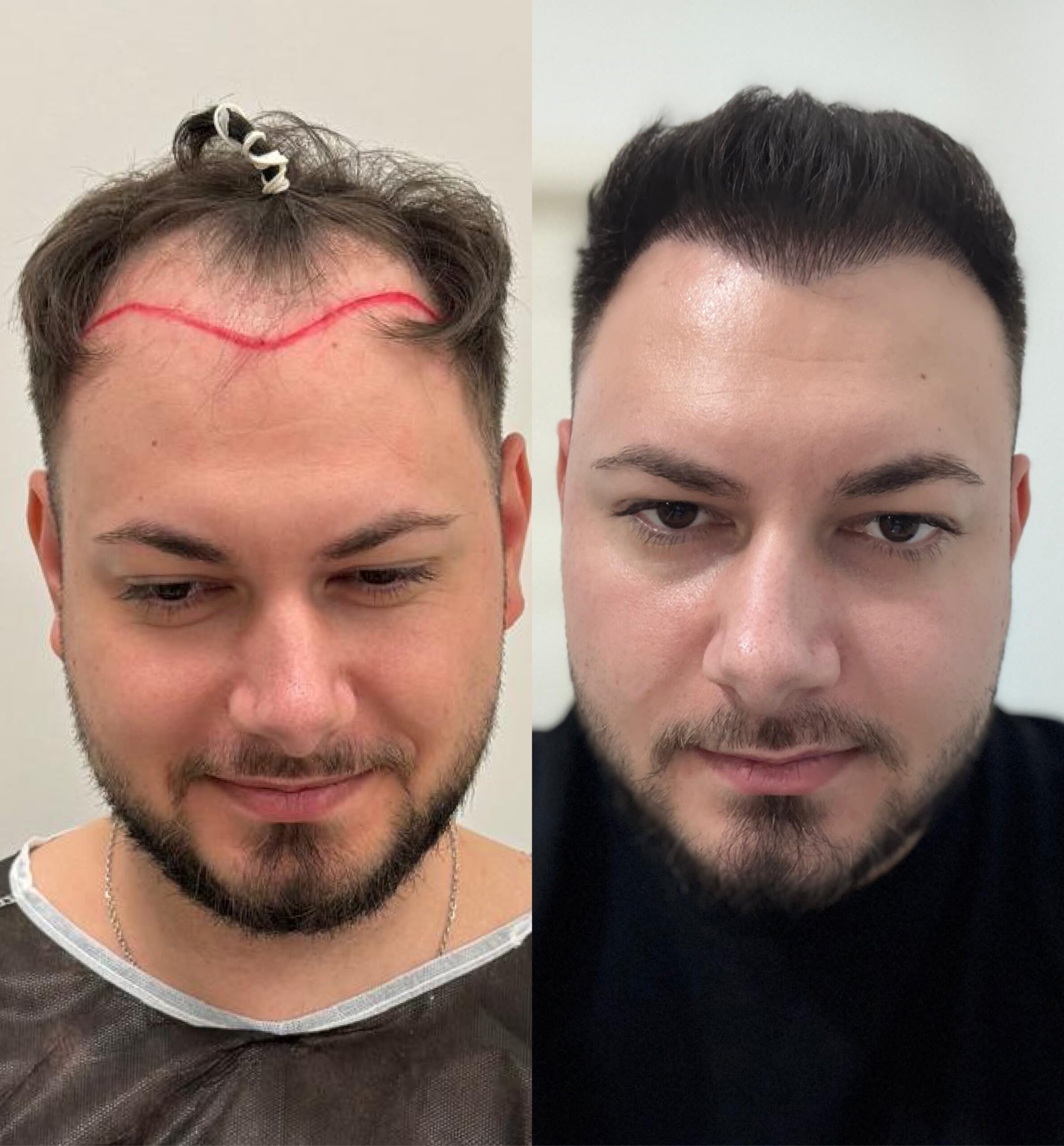 Hair transplant before & after. Man's hair restoration results. See the difference!