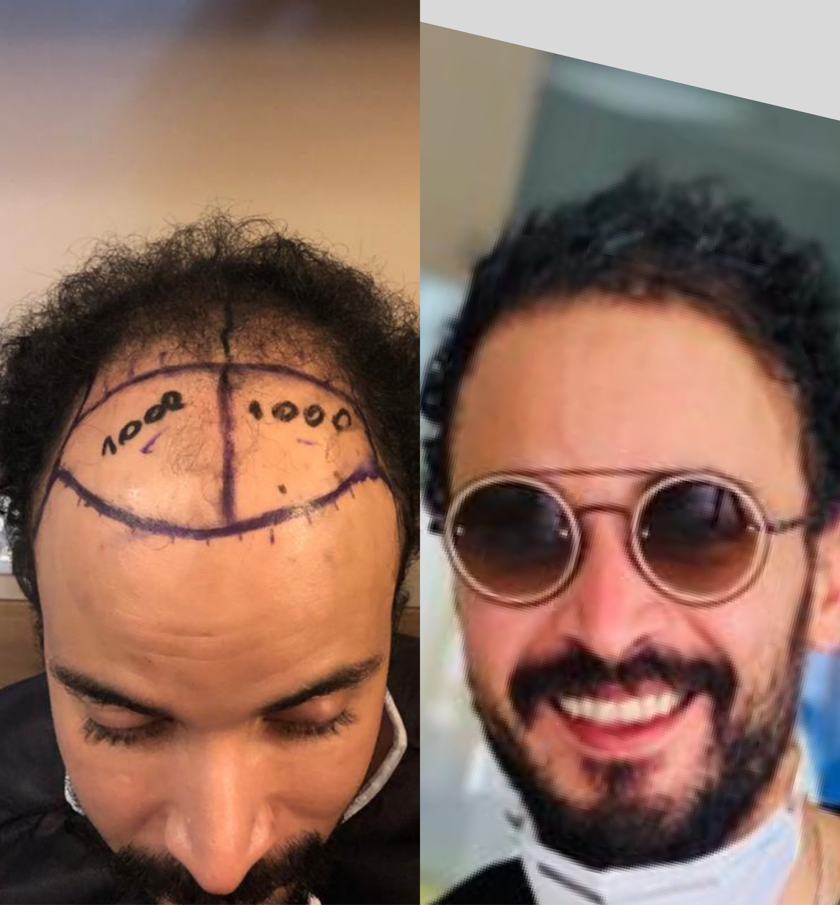 Hair transplant before & after. Man's hair restoration results. See the difference!