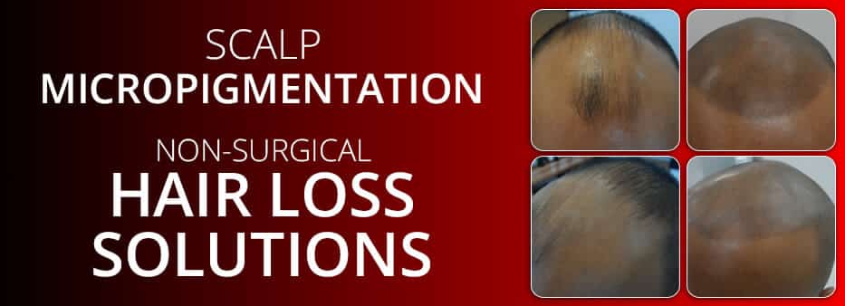Scalp Micropigmentation - MAXiM Hair Restoration - Hair Transplant 