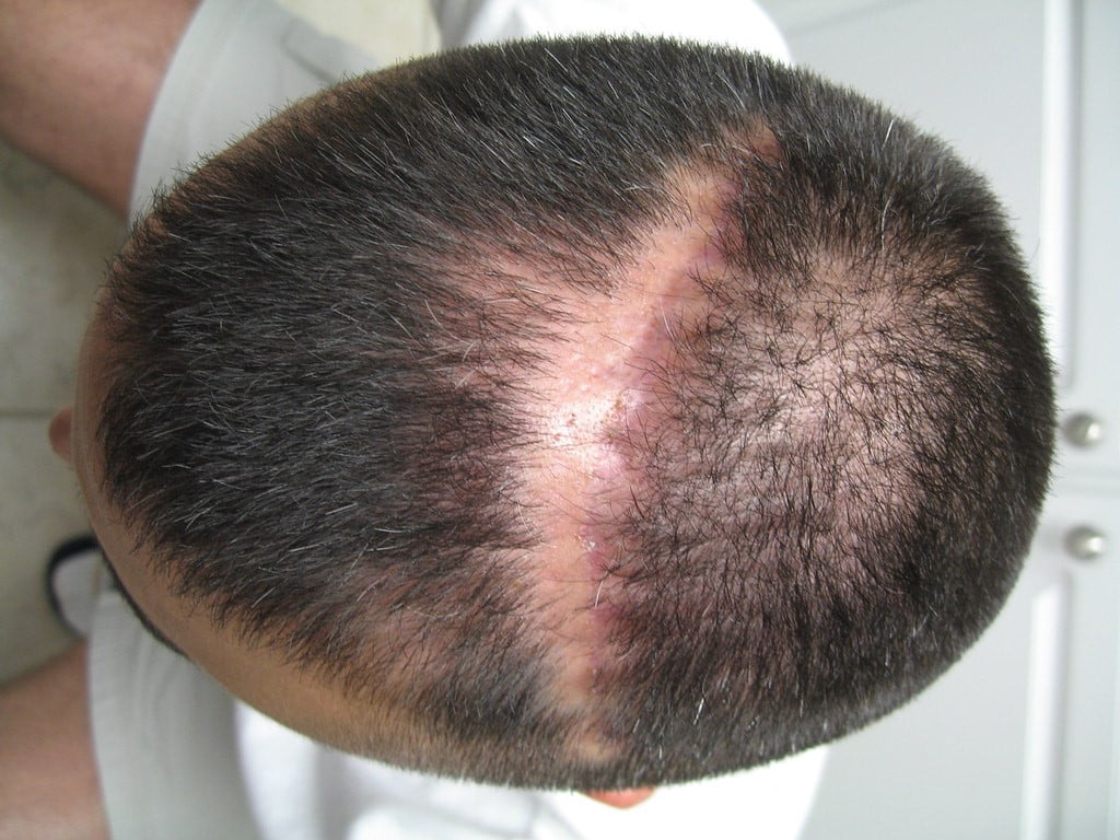 hair transplant scar maxim