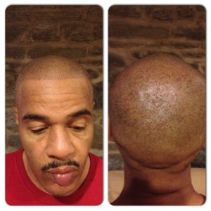 Scalp Micropigmentation - MAXiM Hair Restoration - Hair Transplant 