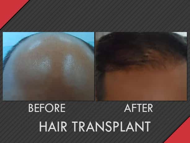 Hair Transplant Services - FUT - MAXiM Hair Restoration
