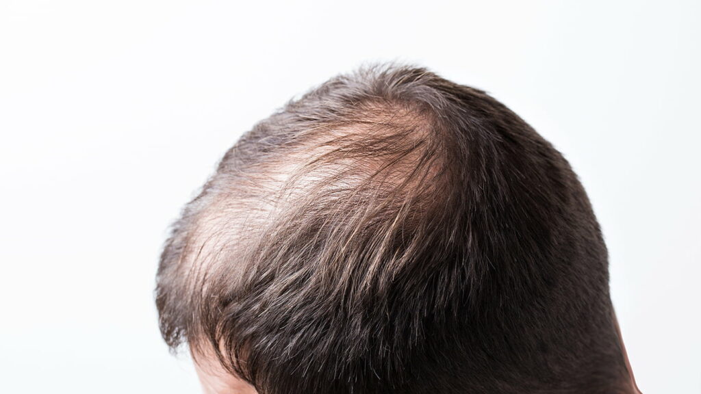 What is Androgenic Alopecia (AA)? Is this a common condition? | MAXIM ...