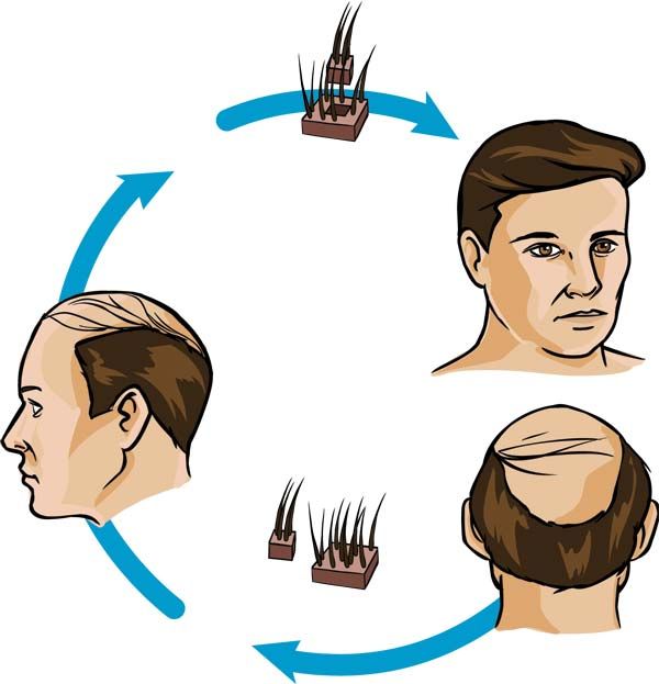 hair plugs treatment hair restoration