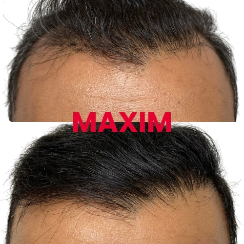 maxim hair restoration houston