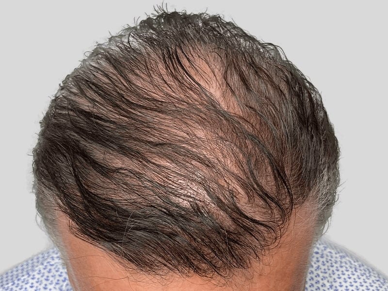 Hair Transplants in Long Island, NY | MAXIM Hair Restoration