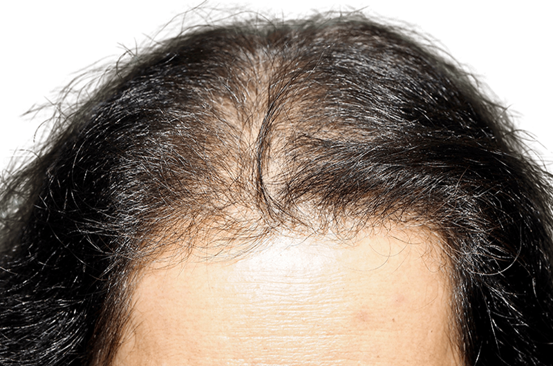 Hair Transplants in Dallas, TX | MAXIM Hair Restoration